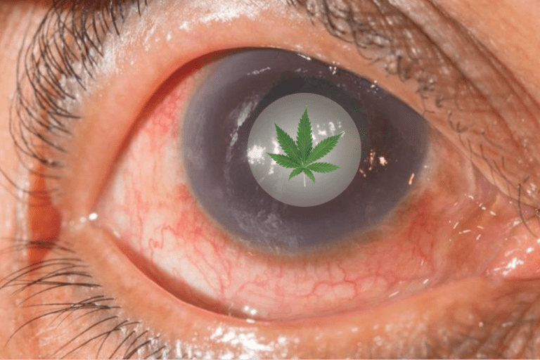 Using Cannabis for Glaucoma